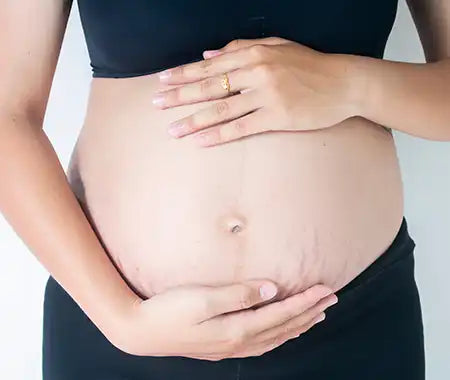 Schwangerschaftsbauch mit Dehnungsstreifen